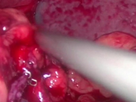 Transección con sonda de termómetro durante la gastrectomía en manga