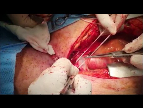 Manejo del paciente con fístula de la arteria traqueoinnominada después de la resección traqueal