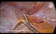 Hidrosálpinx y torsión recurrente de trompas: una complicación tardía de la ligadura de trompas