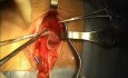 Vídeo de reparación de hernia inguinal.