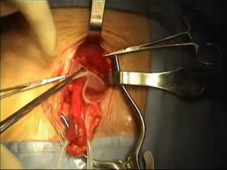 Vídeo de reparación de hernia inguinal.