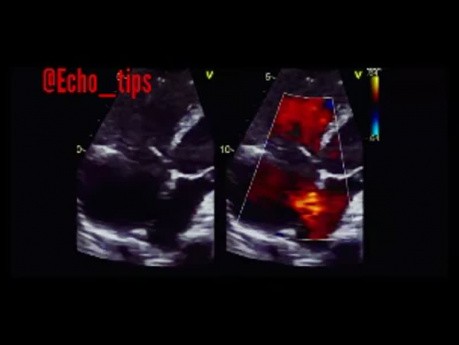 11. Caso de ecocardiografía - ¿Qué se ve?
