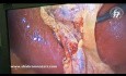 Mecanismos causales de la lesión de las vías biliares