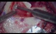 Cirugía de Colesteatoma Abordaje Combinado (Endoscópico y Microscópico)