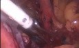 Disección laparoscópica de los ganglios linfáticos pélvicos