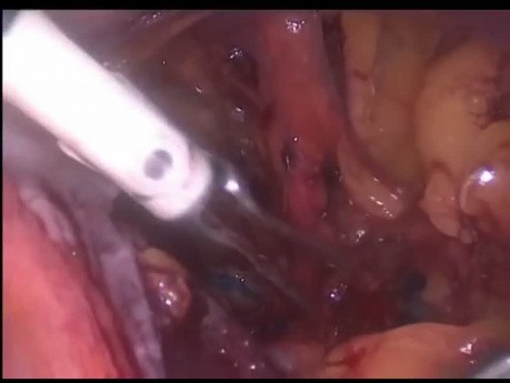Disección laparoscópica de los ganglios linfáticos pélvicos