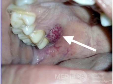 Granuloma gravidarum piógeno en la encía