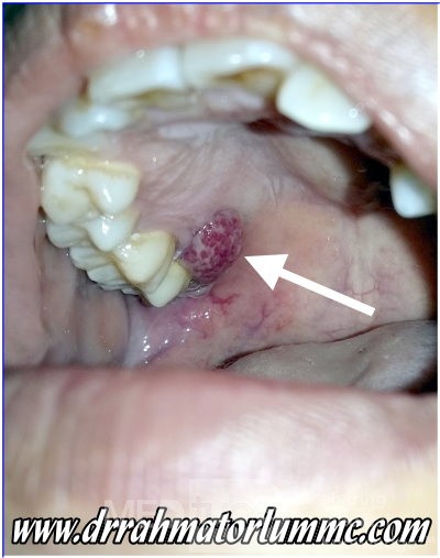 Granuloma gravidarum piógeno en la encía