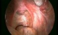 Video de laparoscopia