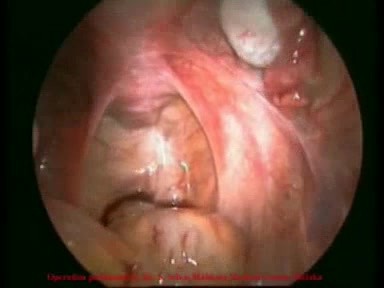 Video de laparoscopia