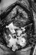 Astrocitoma Quístico de Fosa Posterior