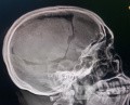 Craniectomía descompresiva en infarto maligno de la arteria cerebral media