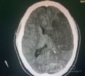Craniectomía descompresiva en infarto maligno de la arteria cerebral media