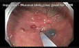 Perforación del colon tras RME - B