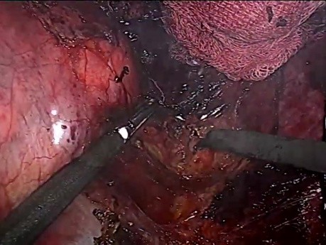 Adrenalectomía derecha laparoscópica para tumor suprarrenal gigante (14 cm)