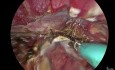 vNOTES Histerectomía para adenomiosis