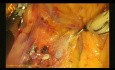 Linfadenectomía laparoscópica para el cáncer de colon derecho