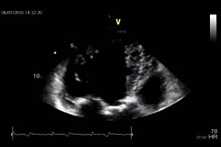 Miocardiopatía no compactada