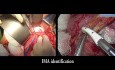 EMT laparoscópica y abierta
