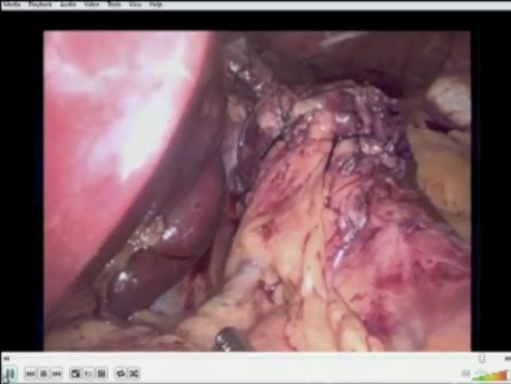 Reparación laparoscópica de hernia hiatal con funduplicatura de Dor tras gastrectomía en manga
