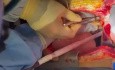 Donación de corazón y pulmones tras muerte cardíaca completa - Parte 1