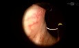 Transurethral Management of Prostate Abscess