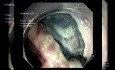 Disección submucosa endoscópica de lesiones vecinas, incluyendo LSTG