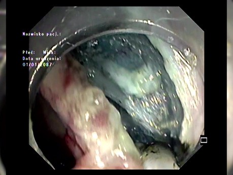 Disección submucosa endoscópica de lesiones vecinas, incluyendo LSTG