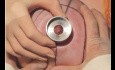 Mamoplastia de reducción