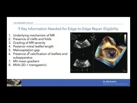 Evaluación ecocardiográfica para la reparación mitral de borde a borde