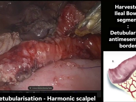 Ileocistoplastia laparoscópica asistida por robot y apendicovesicostomía de Mitrofanoff