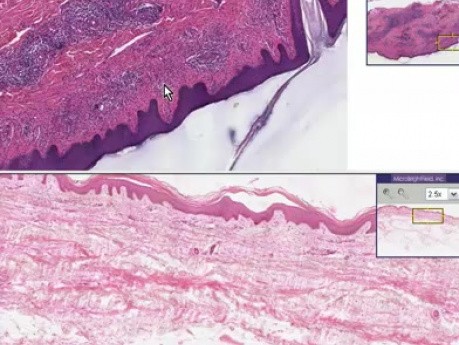 Infiltrado linfocítico - histopatología - piel