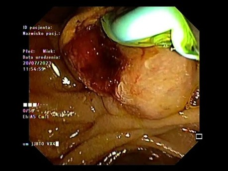 Adenocarcinoma papilar diagnosticado con USE y CPRE