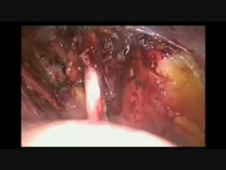 Linfadenectomía pélvica laparoscópica