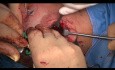 Tratamiento quirúrgico de doble fractura del cóndilo mandibular intra + extracapsular (prof. M. Maglione, Dr. Roberto Rizzo, Universidad de Trieste, Italia)