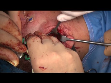 Tratamiento quirúrgico de doble fractura del cóndilo mandibular intra + extracapsular (prof. M. Maglione, Dr. Roberto Rizzo, Universidad de Trieste, Italia)