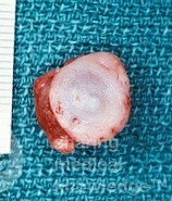 Mucocele del labio [Pieza quirúrgica]