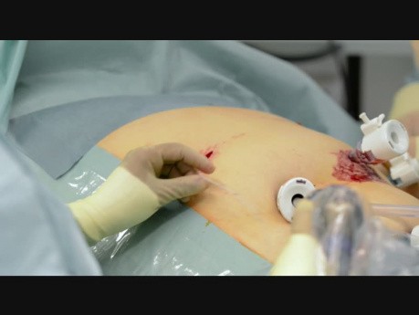 Catéter preperitoneal como terapia de control del dolor después de la cirugía laparoscópica
