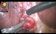 Biopsia del ganglio linfático Porta Hepatis