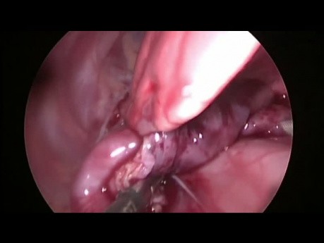 Tratamiento toracoscópico de un quiste mediastínico en un lactante