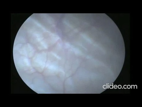 Un caso de cálculo pélvico renal izquierdo grande tratado mediante LEOC con colocación de stent doble J