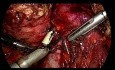 Pancreatoduodenectomía totalmente laparoscópica (Whipple) para el cáncer ampular