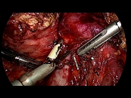 Pancreatoduodenectomía totalmente laparoscópica (Whipple) para el cáncer ampular