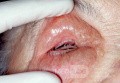 Enfisema orbitario posoperatorio de los senos nasales