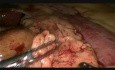 Gastrectomía distal laparoscópica
