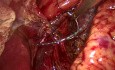 Hernia de hiato axial. Enfermedad por reflujo gastroesofágico.
