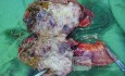 Obstrucción del intestino delgado por linfoma no Hodgkin 2