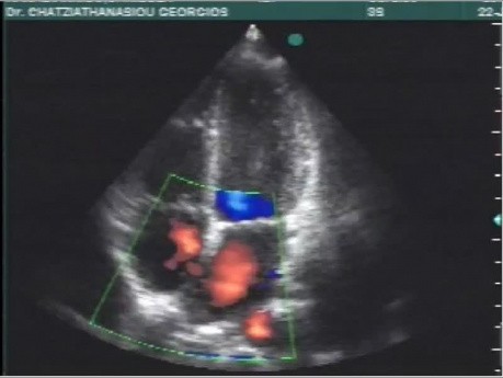 Cuestionario de cardiología numero 3: ECG y ecocardiograma de un paciente con cardiopatía congénita
