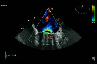 Insuficiencia mitral mecánica