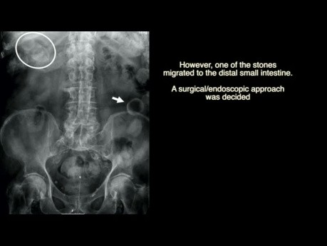 Bouveret Syndrome